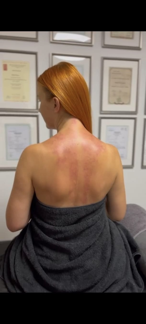 Zabieg Gua Sha pleców